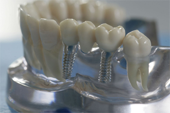 протезирование зубов в клинике МедСоюз