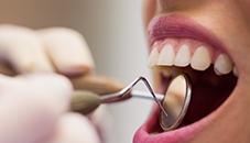 Восстановление всех зубов за 1 день по технологии «All-in-4»